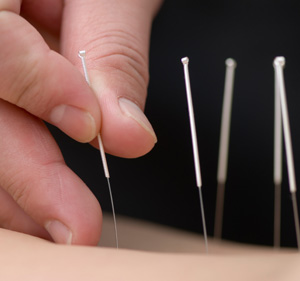 Acupuncture needles